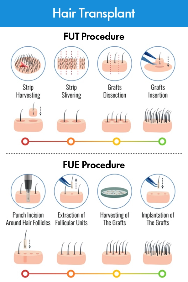 Stages of FUE vs FUT Hair Transplant Techniques - Detailed Comparison