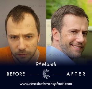 Hair Transplant Man