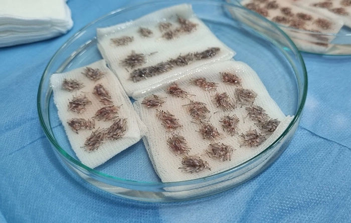 sorting and counting follicular units