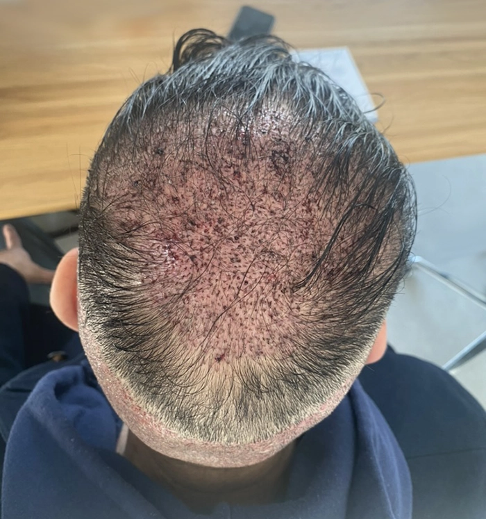 unshaven hair transplant