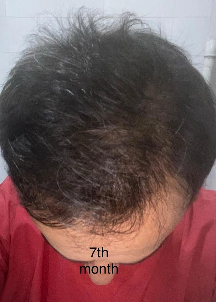 transformation after hair transplant