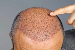 how can I protect my transplanted hairs