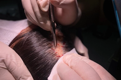 limitations of hair transplantation