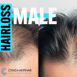 male hair loss