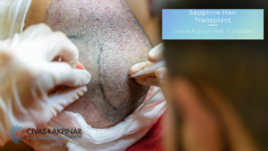 sapphire hair transplant civas hair transplant