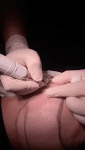 excision-extraction part of hair transplant