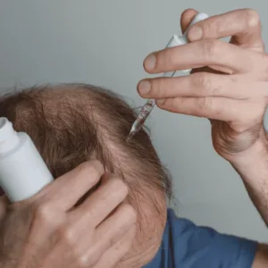 male hair loss treatments