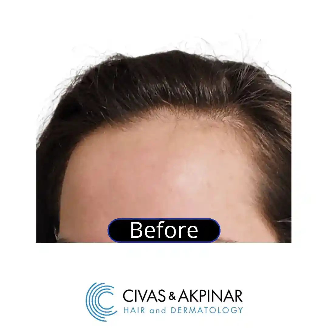 women hair transplant before after results in turkey