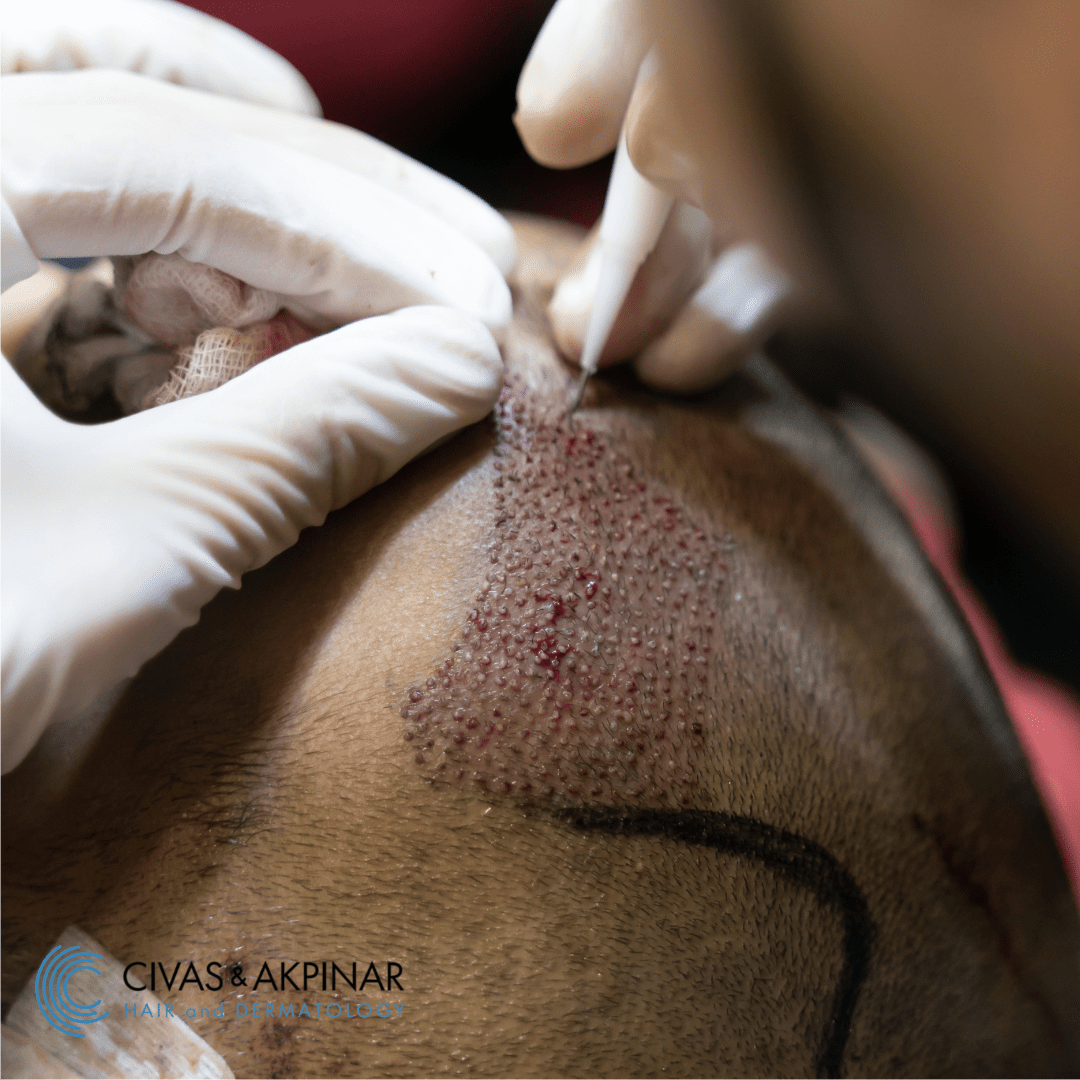 Robotic FUE Hair Transplant