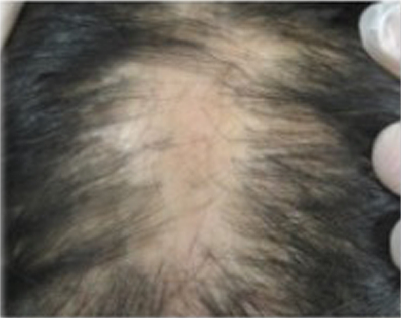 Primary Cicatricial Alopecia