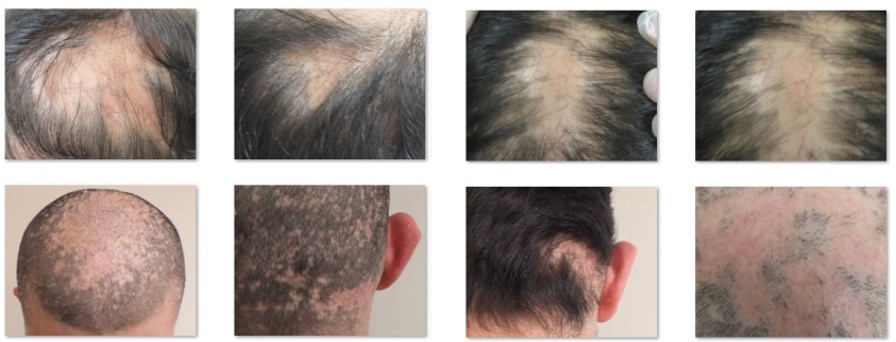 Primary Cicatricial Alopecia Scarring Alopecias