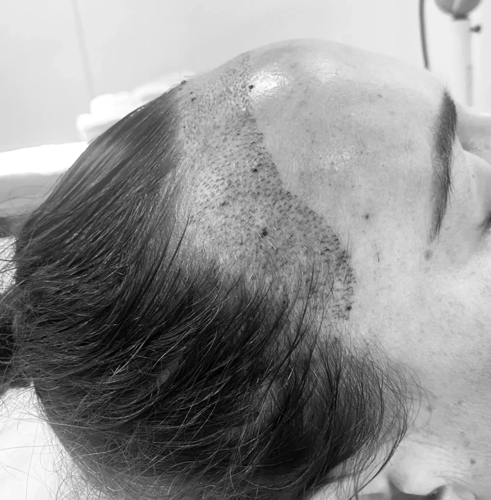 hair transplant for women1