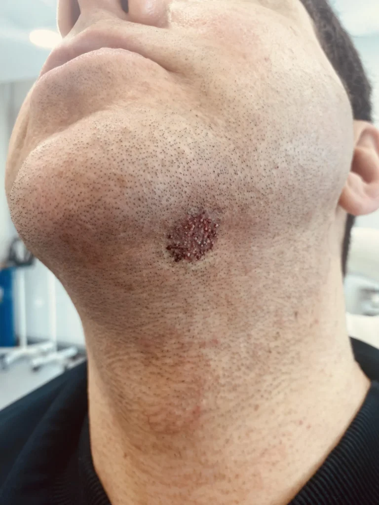 Facial Hair Transplant
