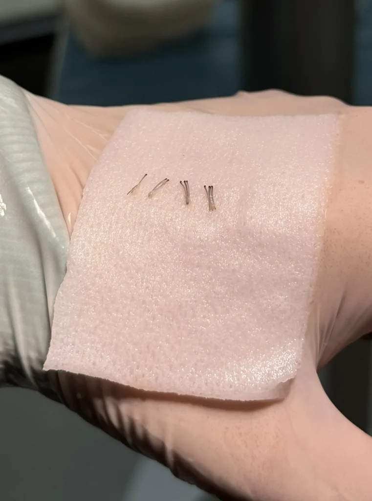 Grafts being counted and sorted individually during FUE hair transplant procedure