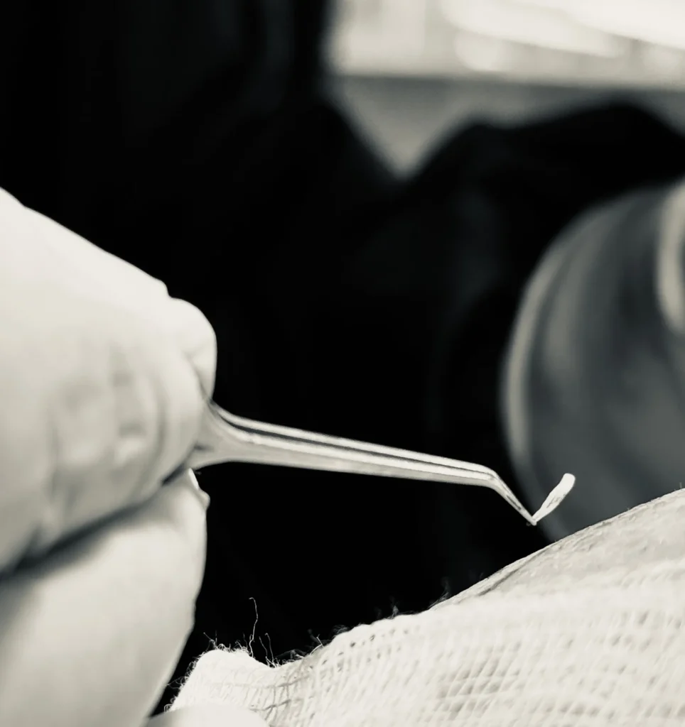 Grafts being counted and sorted individually during FUE hair transplant procedure