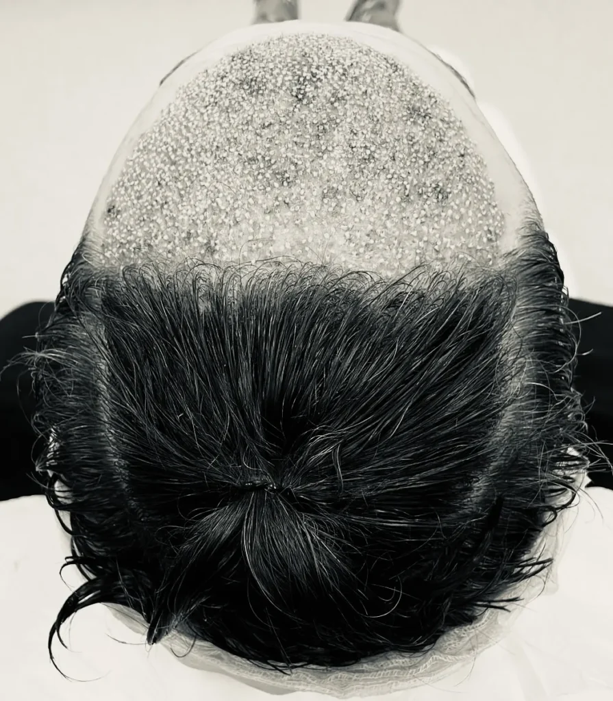 unshaven FUE or U-FUE hair transplant