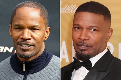did jamie foxx have a hair transplant