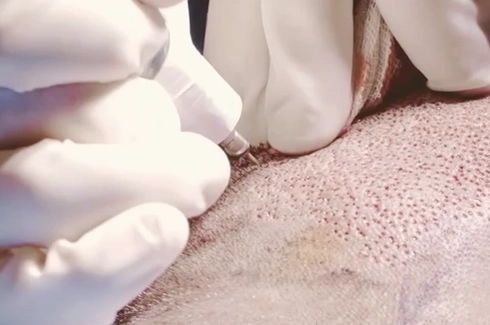 hair transplantation have side effects