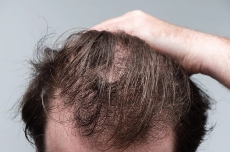 hair-loss