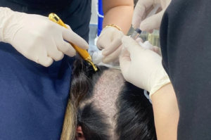 Is Unshaven FUE Possible