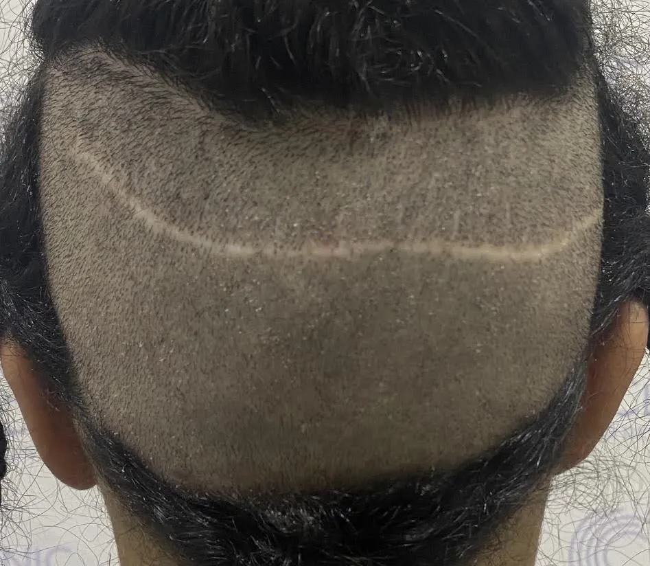 FUT Hair Transplant: Linear scar at the back of the head