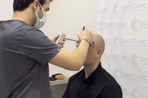 which age is best for hair transplant