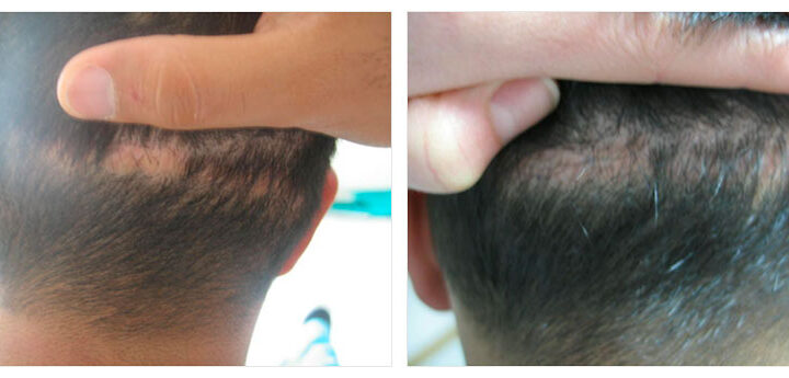 FUT Scar Revision: Before & After