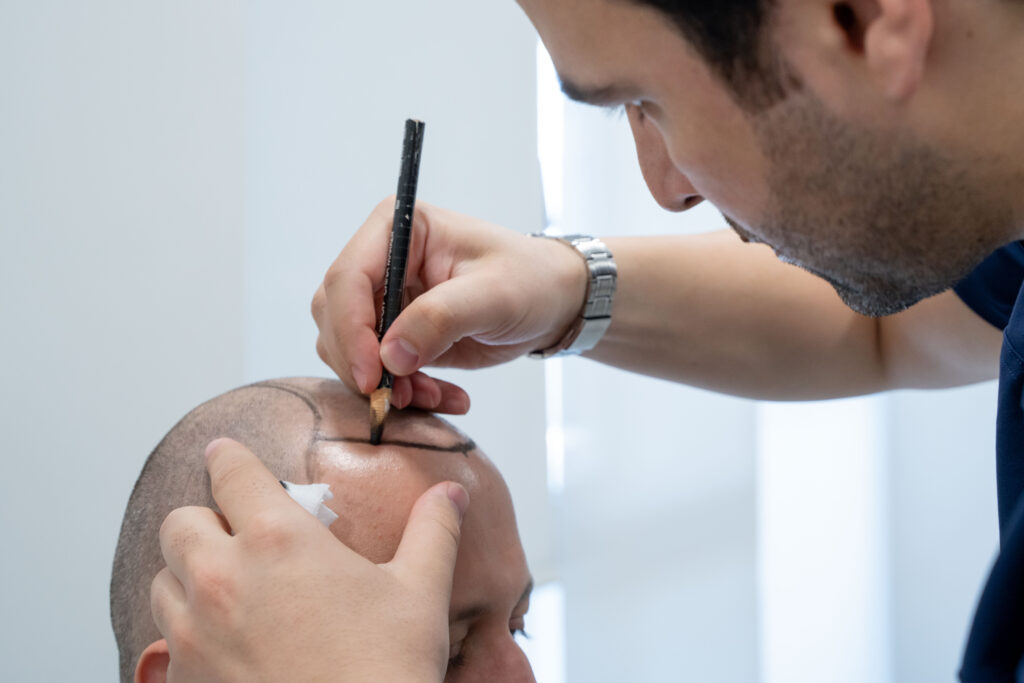 Hairline Design for Hair Transplant