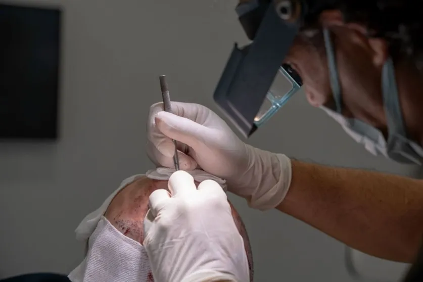 Hair Transplant Techniques: doctor performing channel opening (incisions) during FUE hair transplant