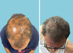 Lichen Planopilaris Hair Transplant Before After Photos