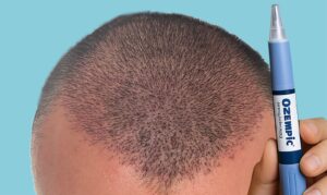 Ozempic and Hair Transplant