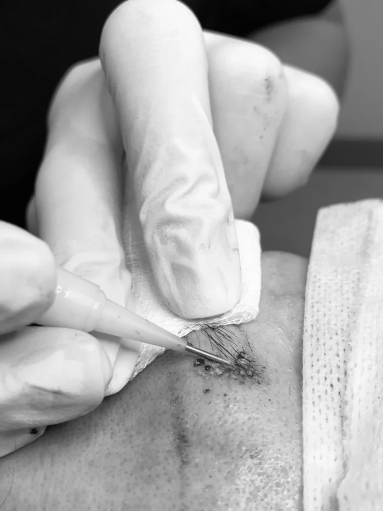 eyebrow_transplant_1