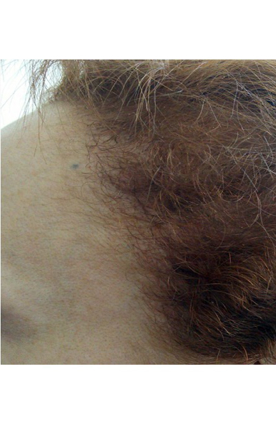 Traction Alopecia before