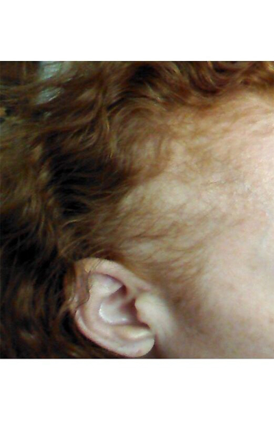 Traction Alopecia Before