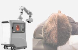 AI-Assisted Hair Transplantation