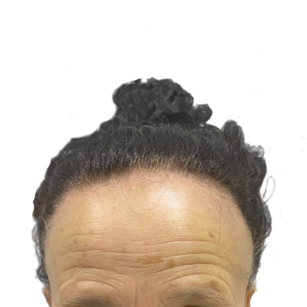 Frontal Fibrosing Alopecia Hair Transplant: Before
