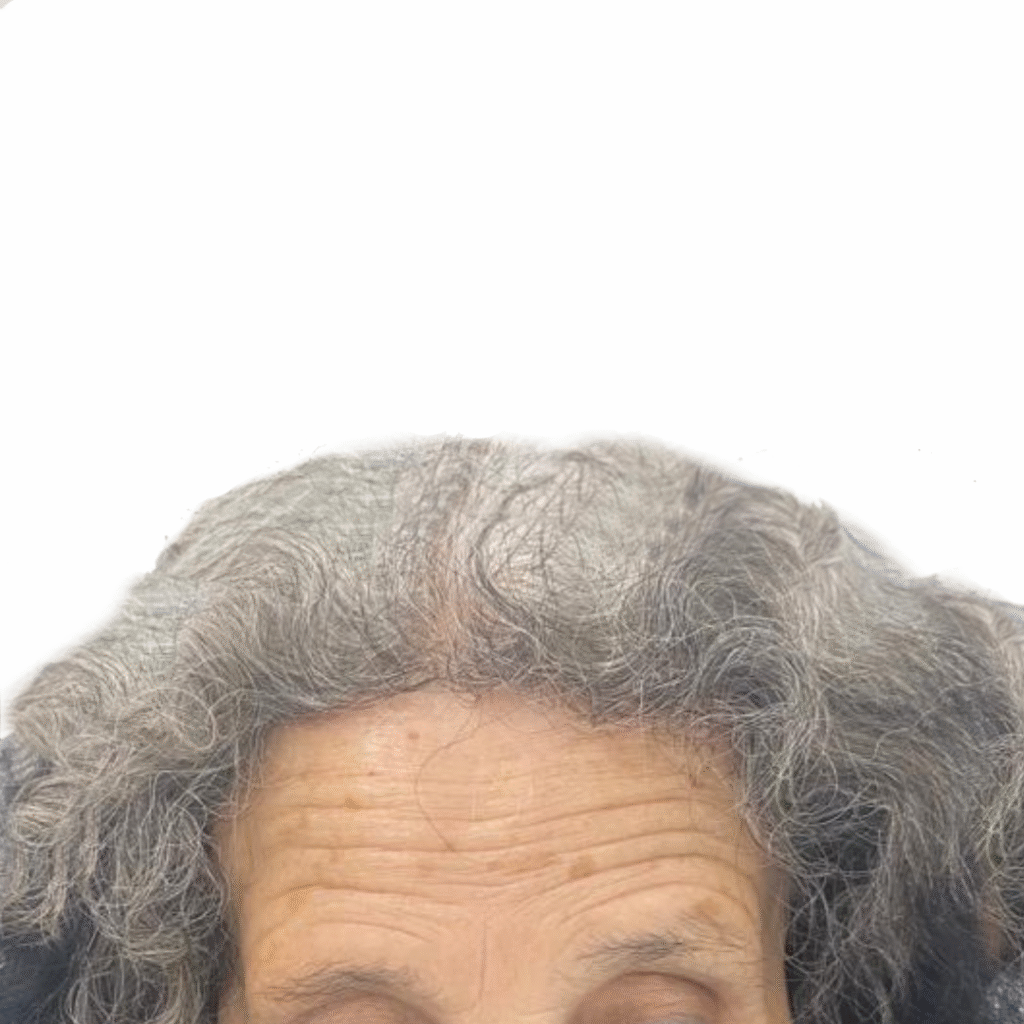 Frontal Fibrosing Alopecia Hair Transplant: After