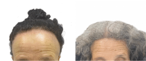 Frontal Fibrosing Alopecia