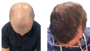 Hair Transplant Success Rate
