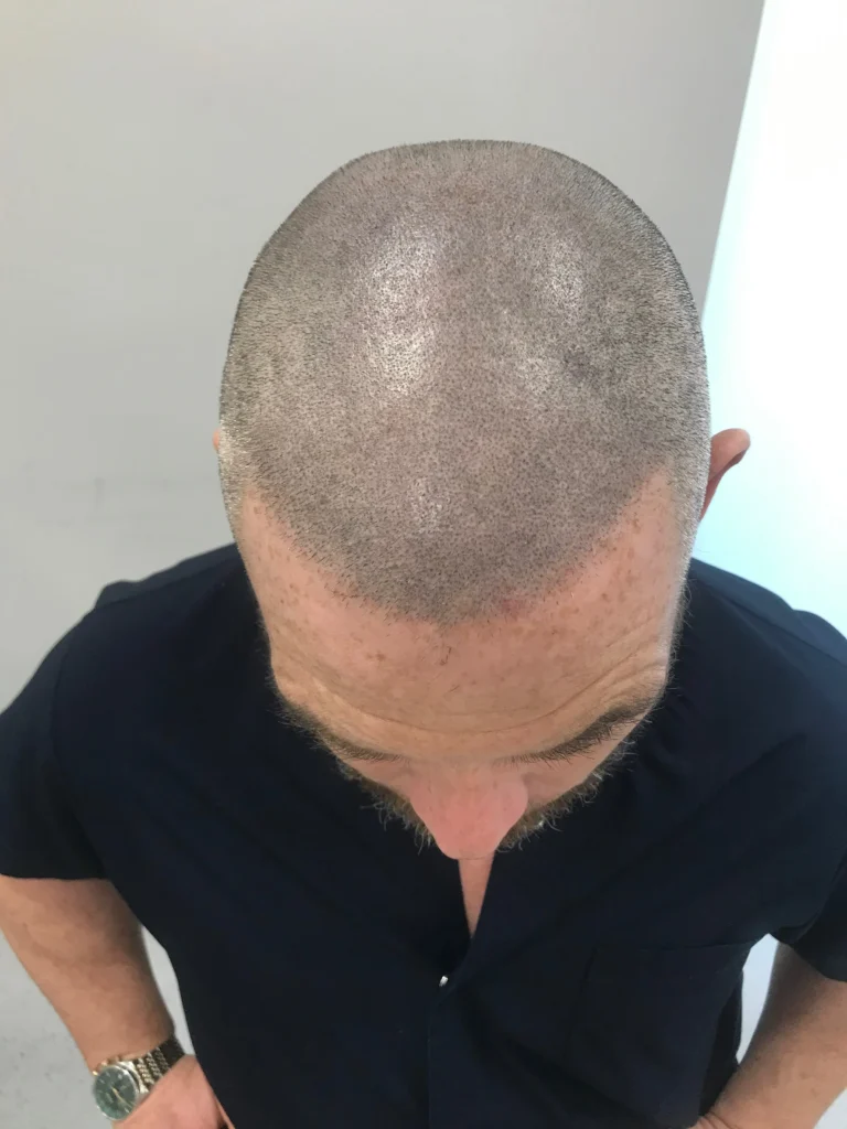 should you wear a Hat after hair transplant