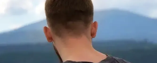 Retrograde Alopecia