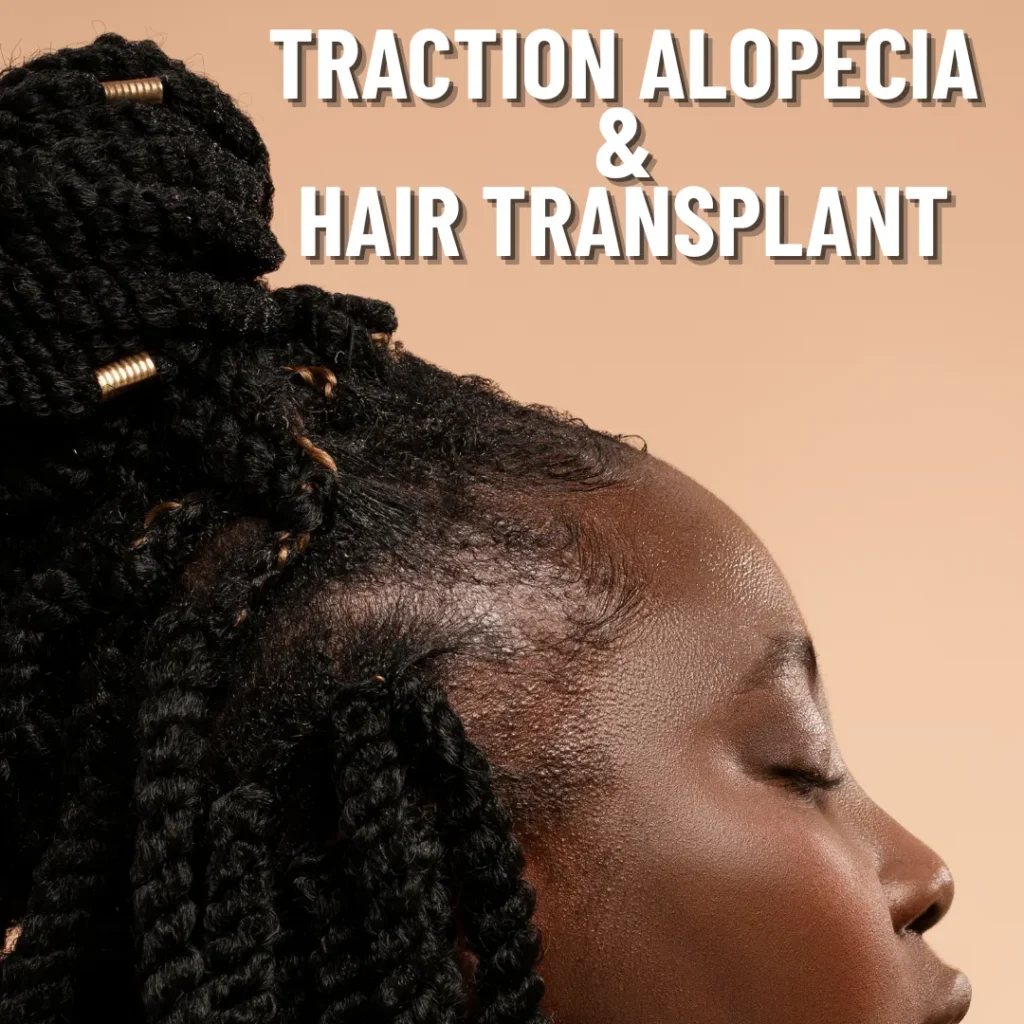 TRACTION-ALOPECIA_hair-transplant