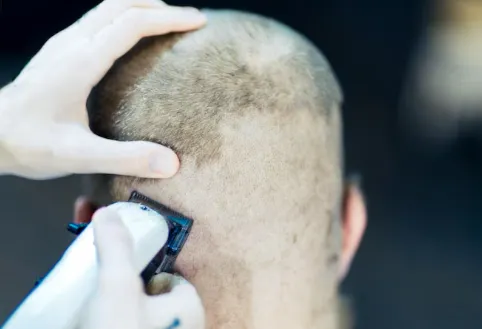 Unshaven Follicular Unit Extraction