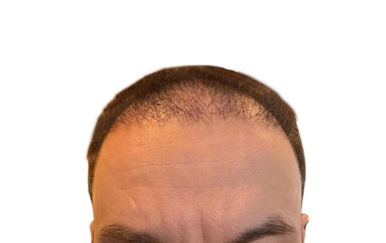 Hair Transplant Recovery Timeline: Day 15-1