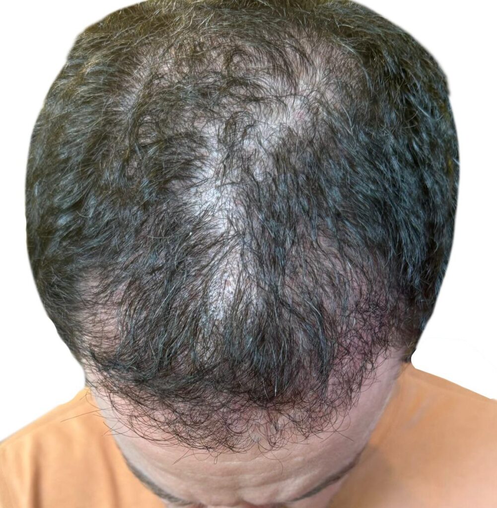 Hair Transplant Recovery Timeline: Day 30-2