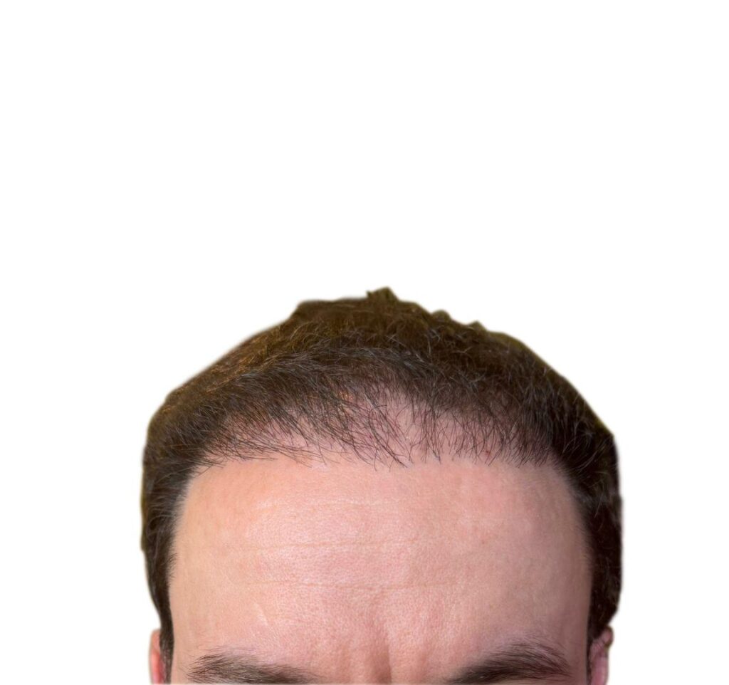 Hair Transplant Recovery Timeline: Day 30-1