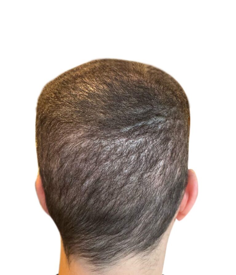 Hair Transplant Recovery Timeline: Day 15-3
