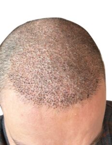 Hair Transplant Recovery Timeline: Scabbing