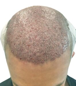 Hair Transplant Recovery Timeline: Day 1-2