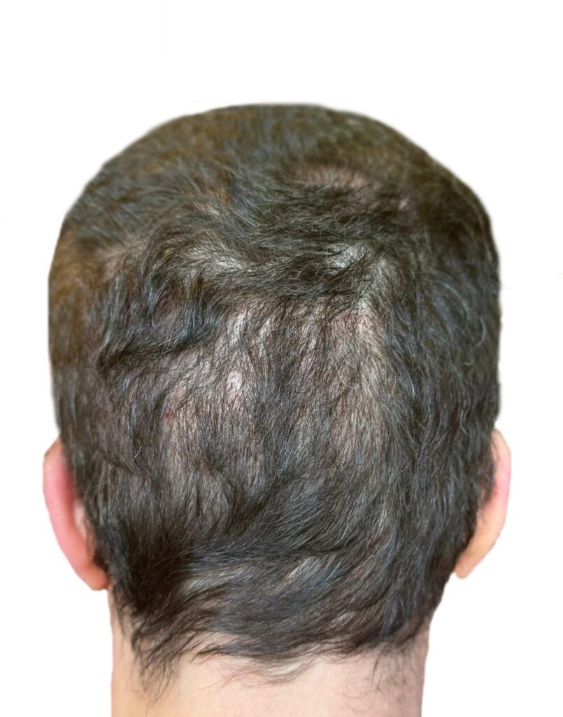 Hair Transplant Recovery Timeline: Day 30-3